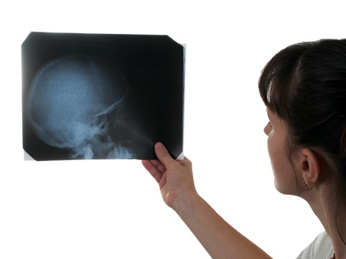 Skull Fractures Birth Injury Lawyer