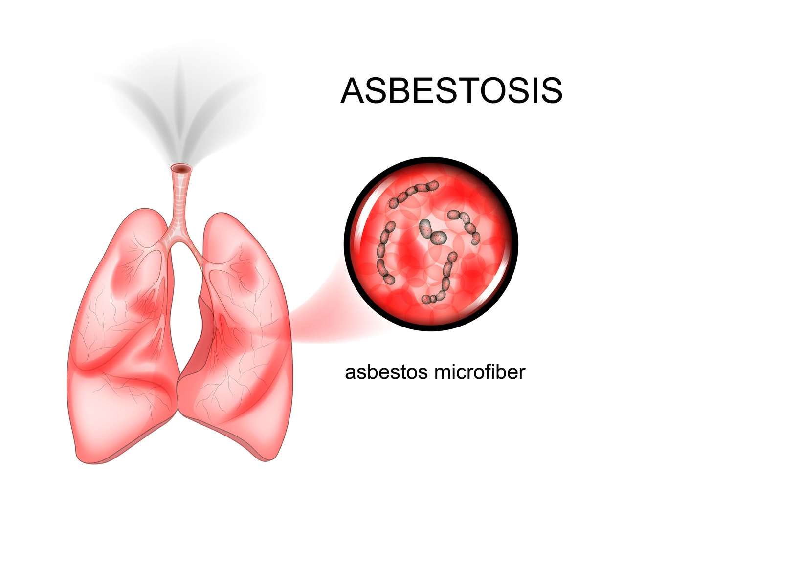 Asbestosis & Medical Malpractice Law