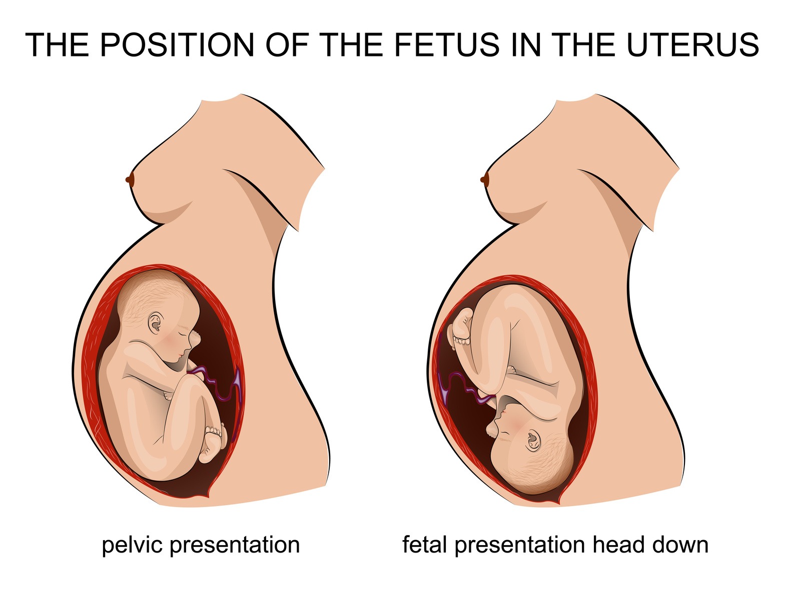 breech-baby-positions